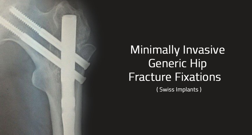 Minimally invasive fracture fixation